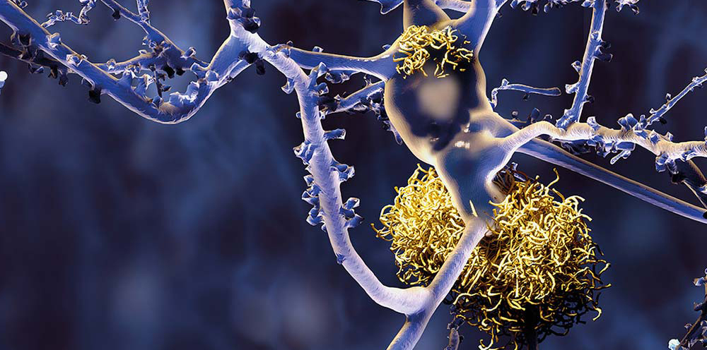 Détection des biomarqueurs sanguins d'Alzheimer